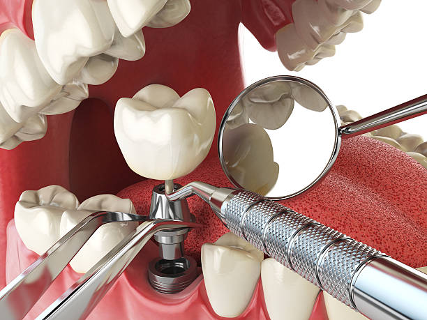 Best Emergency Tooth Extraction in Danville, KY